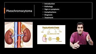 Image result for 5 Ps of Pheochromocytoma