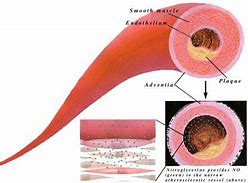 Image result for Angina Pectoris Anatomical Position