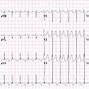 Image result for Atrioventricular Reciprocating Tachycardia