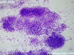 Image result for Adrenal Cytology