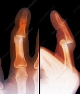 Image result for Dislocated Finger Joint