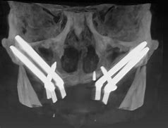 Image result for Zygomatic and Pterygoid Implants