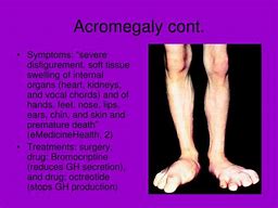 Image result for Gigantism Acromegaly and Dwarfism