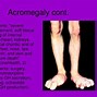 Image result for Gigantism Acromegaly and Dwarfism