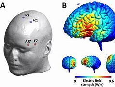 Image result for What Is a tDCS