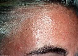 Image result for Bacterial Folliculitis Scalp