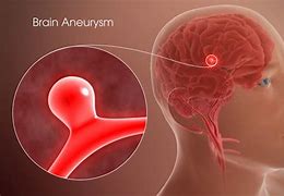 Image result for Unruptured Aneurysm