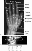 Image result for Bone Age Hand X-ray