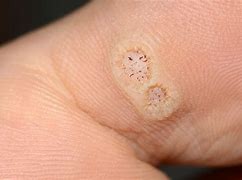 Image result for Plantar Wart On Kids Foot