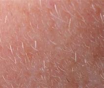 Image result for Mites Living On Face