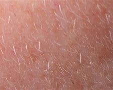 Image result for Mites On Face