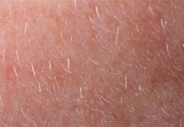 Image result for Human Skin Mites