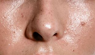 Image result for Hard Sebum in Pores