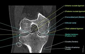 Image result for CT Knee Radiopaedia