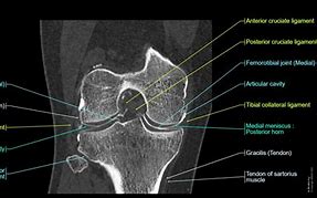 Image result for CT Knee Point Graph