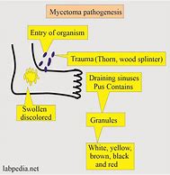 Image result for Mycetoma