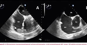 Image result for Right Atrial Appendage Fetal Echo