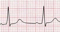 Image result for Heart Failure Electrocardiogram