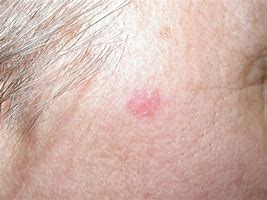 Image result for Basal Cell Carcinoma Cancer Symptoms