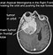 Image result for Meningioma CT Head