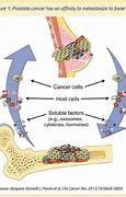 Image result for Cancer Bone Metastasis