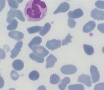 Image result for Pyropoikilocytosis