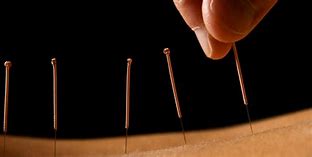 Image result for Acupuncture