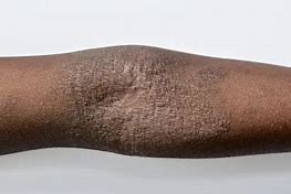 Image result for Eczema On Darker Skin