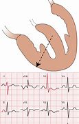 Image result for RVH ECG