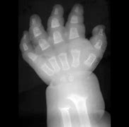 Image result for Trident Hand Achondroplasia