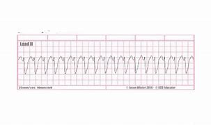 Image result for Unifocal PVC Bigeminy