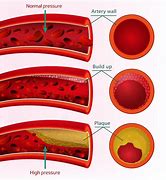 Image result for High Blood Pressure Cardiovascular Disease