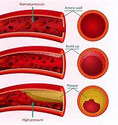 Image result for High Blood Pressure Arteries