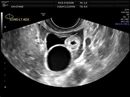 Image result for Ectopic Pregnancy Ultrasound 12 Weeks