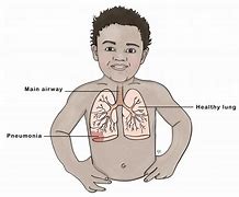 Image result for Childhood Pneumonia