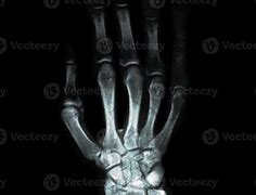 Image result for Bone Age Hand X-ray