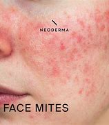 Image result for Mites On Face Skin Infection