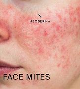 Image result for Mites On Face