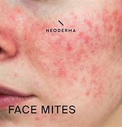 Image result for Mites Living On Face