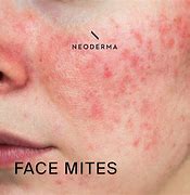 Image result for Face Mites