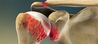 Image result for Arthritc Shoulder