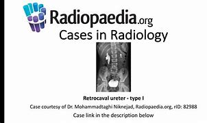 Image result for Retrocaval Surter Radiology