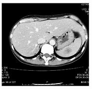 Image result for Spleen Metastasis