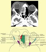 Image result for Subperiosteal Abscess Orbital Cellulitis