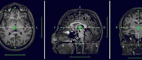 Image result for Coronal Plane Brain MRI