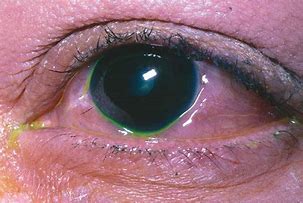 Image result for Uveitis Vision