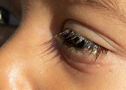 Image result for Mites On Lashes