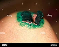 Image result for Knee Scab