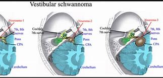 Image result for Vestibular Schwannoma Gross Pathology