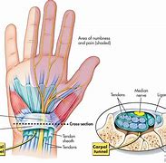 Image result for Carpal Tunnel Syndrome Treatment